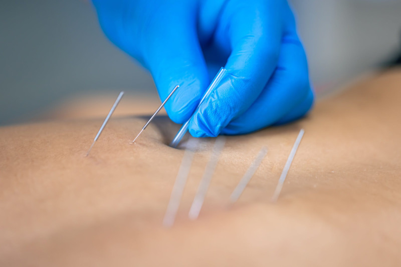 What is Dry Needling Treatment?